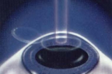lasik